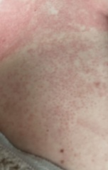 Rash pics!