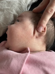 Does anyone know if this rash looks like CMPA?