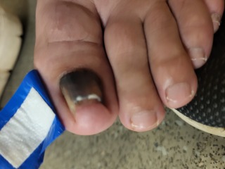 Will they remove my toenail?