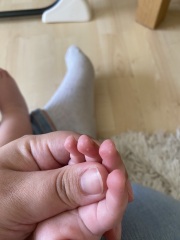 Baby skin blisters?