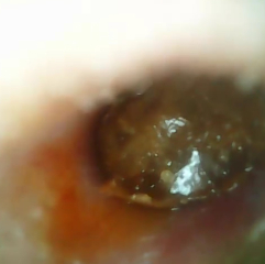 Suspected cholesteatoma