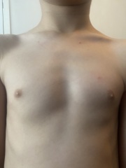 38 weeks pregnant and think DS has chickenpox