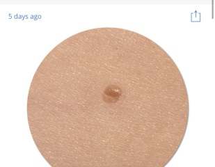 Worried about dodgy looking mole!