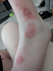 Rash on DS's leg - don't know what else to try....any ideas please? [pic included]