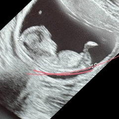 13 weeks any guesses girl or boy?