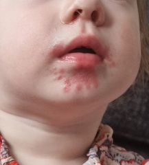 Could this be HFM or Impetigo?