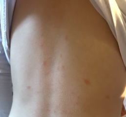 What are these spots on my son’s skin?