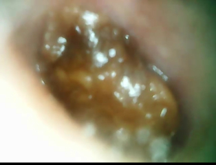 Suspected cholesteatoma