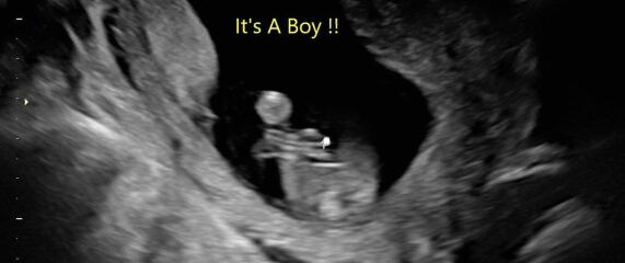 It’s a BOY! But sooo confused about what the scan picture shows…please help!