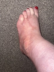 What is wrong with my foot?  - warning - Horrible picture