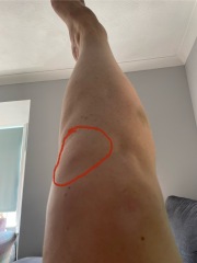 Lump under knee