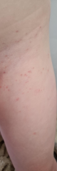 Does this look like a heat rash?