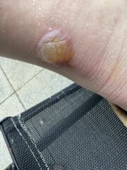 Need advise- am I worrying too much (disgusting photo alert)