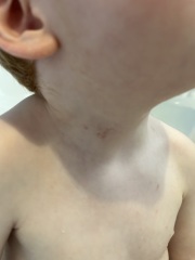 Mark on Childs neck