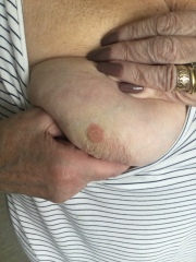 Scared it might be inflammatory breast cancer