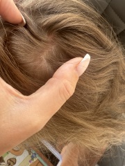 Cradle cap in 6 year old