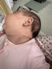 Does anyone know if this rash looks like CMPA?