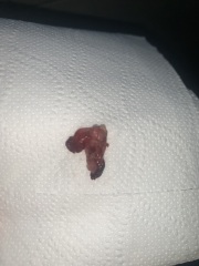 TW GRAPHIC PHOTO- missed miscarriage or clot?