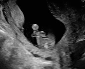 It’s a BOY! But sooo confused about what the scan picture shows…please help!