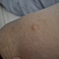 What's this lump I now have??