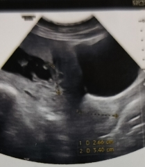 Early Glimpse 98% confidence / nub theory