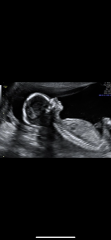 Can a 17 week boy gender scan be wrong?