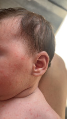 Baby acne or CMPA rash