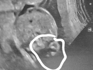 Gender guesses 21 week scan