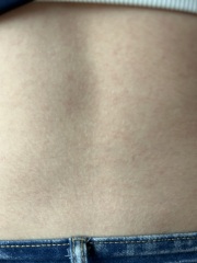 Can anyone identify this rash?