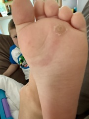 Verucca with red mark along foot???!