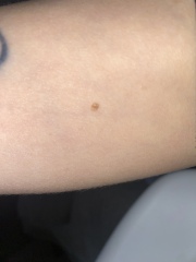 Worried about dodgy looking mole!