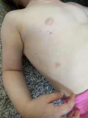 Impetigo? Or something else? Currently pregnant and anxious