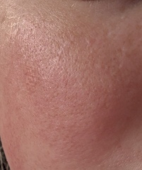 Skin concern