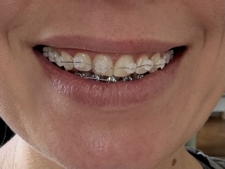 Adult braces - experience