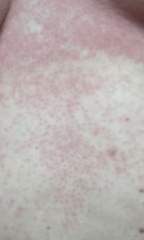 Rash pics!