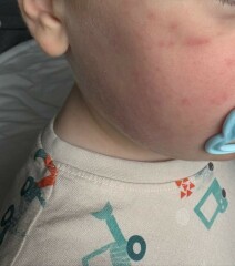 Roseola or stomach virus?