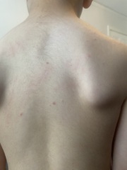 38 weeks pregnant and think DS has chickenpox