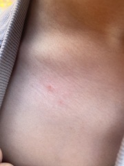 38 weeks pregnant and think DS has chickenpox