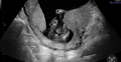 It’s a BOY! But sooo confused about what the scan picture shows…please help!