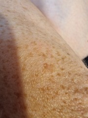 Does this look like skin cancer?