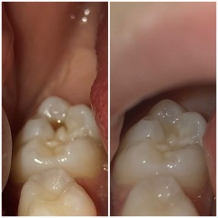 Toddler molar problem potentially