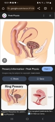Please tell me about your ring pessary!! Is this normal?