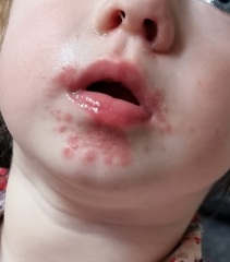 Could this be HFM or Impetigo?