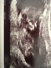 Nub theory guesses 12 week scan 💕💙