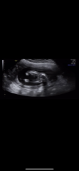 Can a 17 week boy gender scan be wrong?