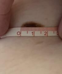 Worried about this mole