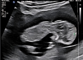 Boy or girl? 12 week scan