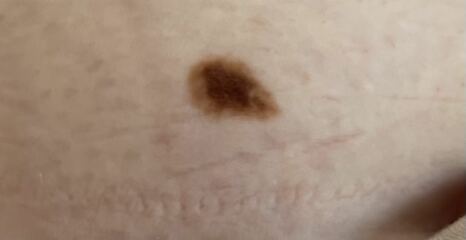 Worried about this mole
