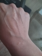 Possible psoriatic arthritis- any early experiences?