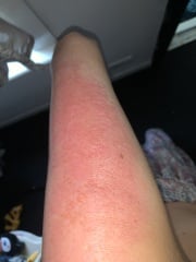 HELP!!!! Veet burn
